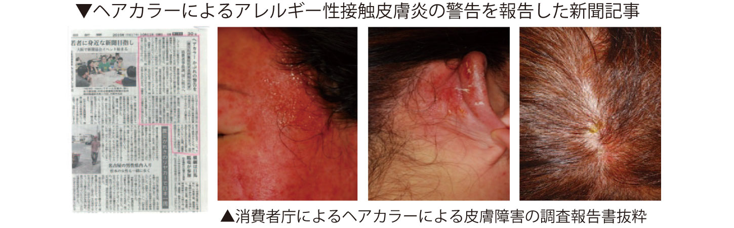 ヘアカラーによるアレルギー性接触皮膚炎の警告を報告した新聞記事